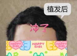 -大麦微针植发全国连锁