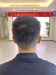 -大麦微针植发全国连锁