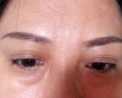 -天津健丽·去眼袋医疗美容机构