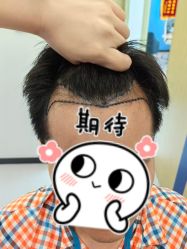 -大麦微针植发全国连锁