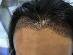 -碧莲盛·不剃发植发