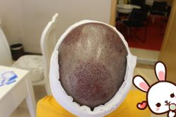 点击看大图 -大麦微针植发丨全国连锁