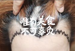 -大麦微针植发全国连锁