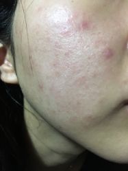 -清颜堂丨分子祛痘·功效美肤