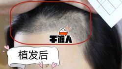 -大麦微针植发全国连锁