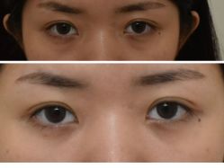 -广州健丽·去眼袋医疗美容机构