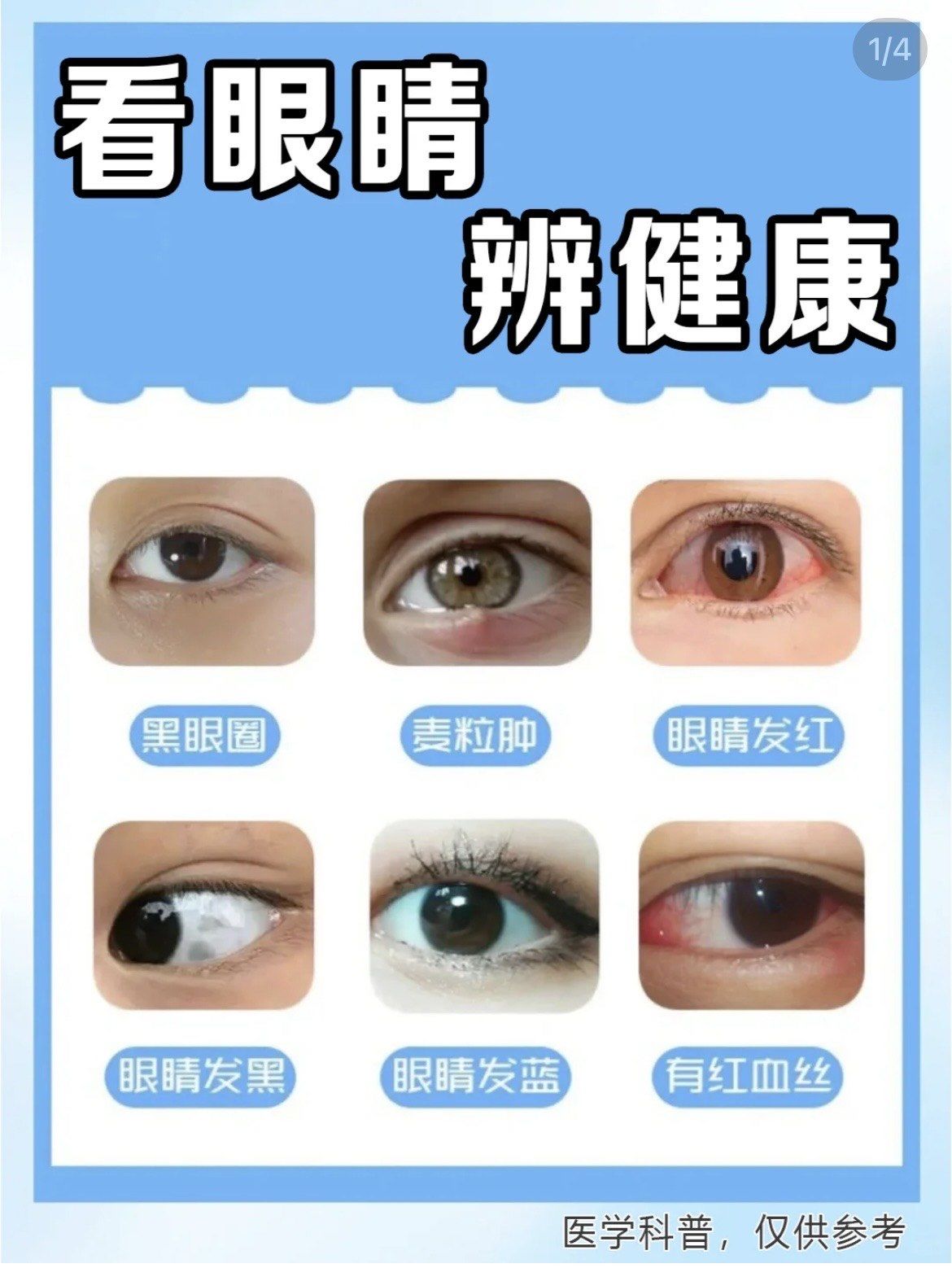 看眼睛辨别身体健康