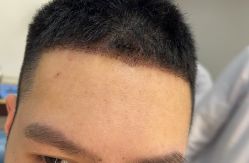 -大麦微针植发全国连锁