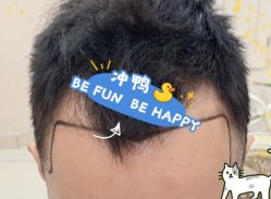 -大麦微针植发全国连锁