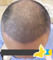 -大麦微针植发丨全国连锁