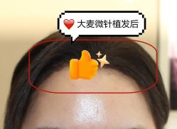 -大麦微针植发全国连锁