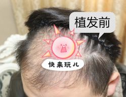 -大麦微针植发全国连锁