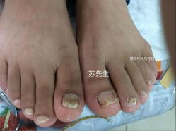 点击看大图 -德哥灰指甲脚气甲沟炎跖疣护理