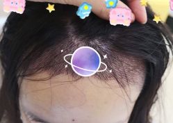 -大麦微针植发全国连锁