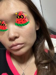 体验后-More摩尔医美の注射线雕光电中心