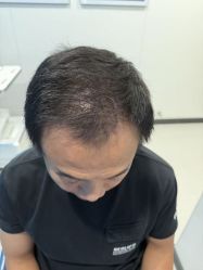 -大麦微针植发全国连锁