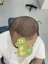 -大麦微针植发全国连锁