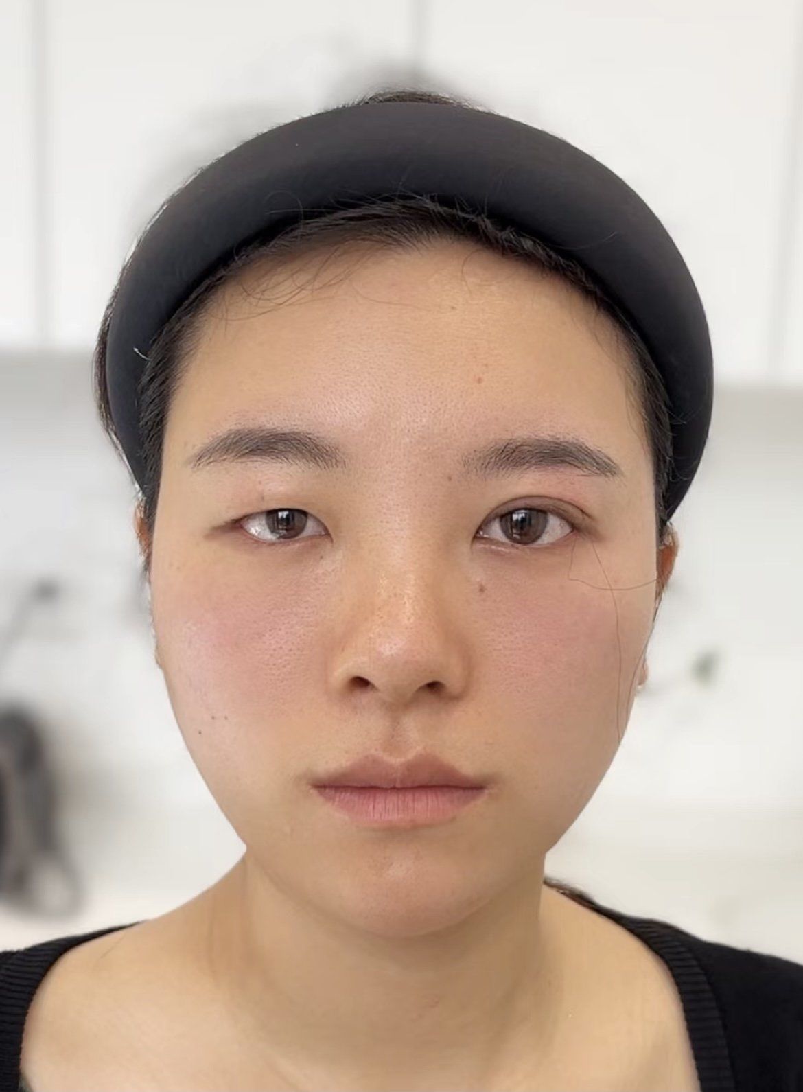 闭眼基本没痕迹了 术后个人感受