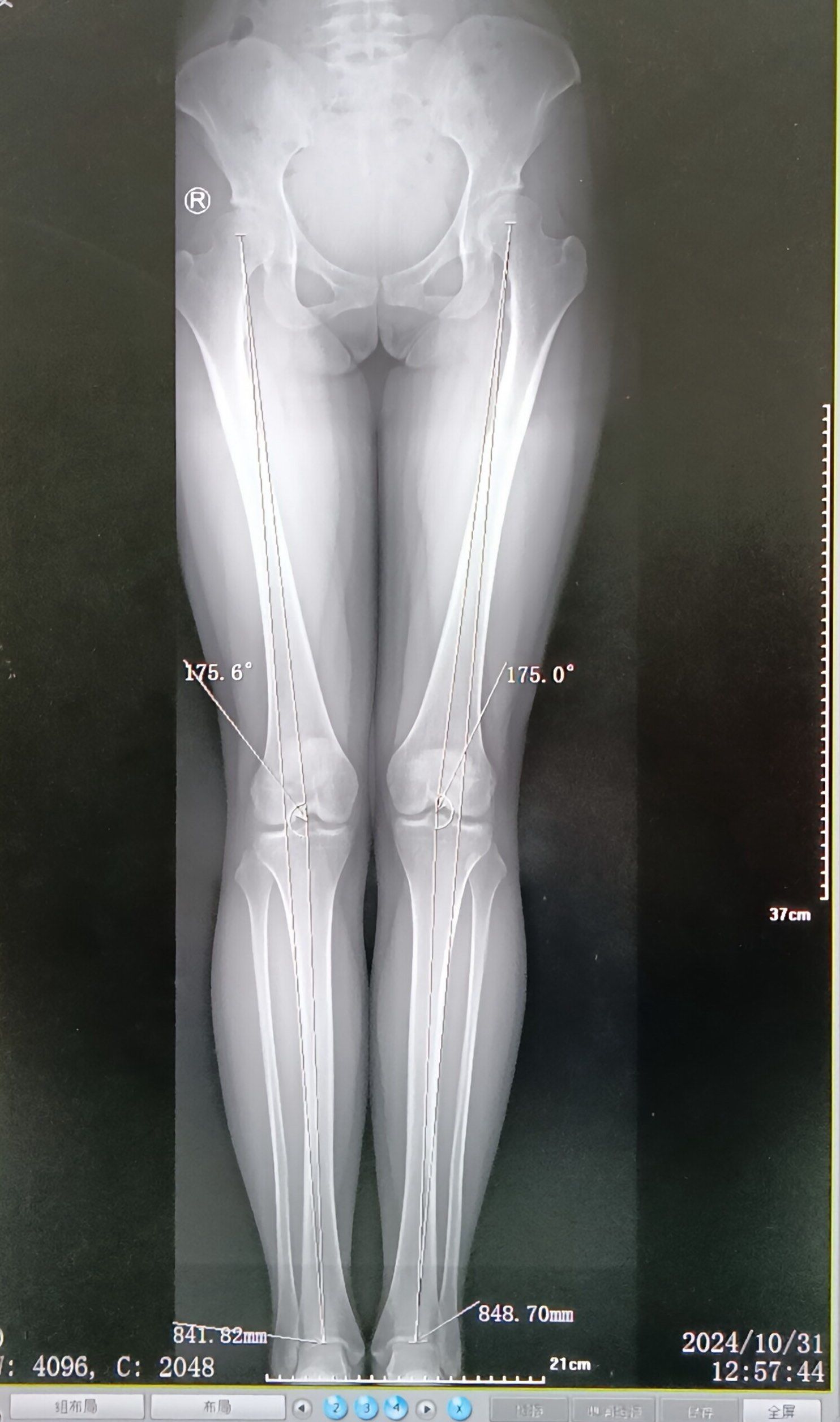 成长轨迹:骨骼x光对比
