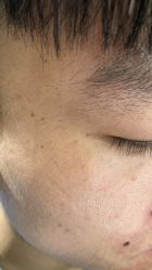 点击看大图 -痣斑堂·取大痣