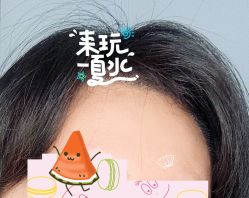 -大麦微针植发全国连锁