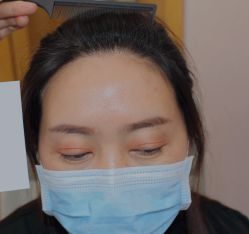 体验后-大麦微针植发全国连锁