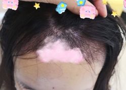 -大麦微针植发全国连锁