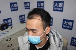 点击看大图 体验前-大麦微针植发丨全国连锁