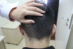 点击看大图 -大麦微针植发丨全国连锁