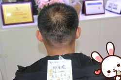 点击看大图 -大麦微针植发丨全国连锁