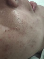 -苗方清颜祛痘·皮肤管理