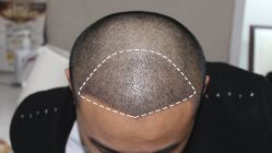 -大麦微针植发丨全国连锁