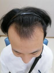 体验前-大麦微针植发丨全国连锁