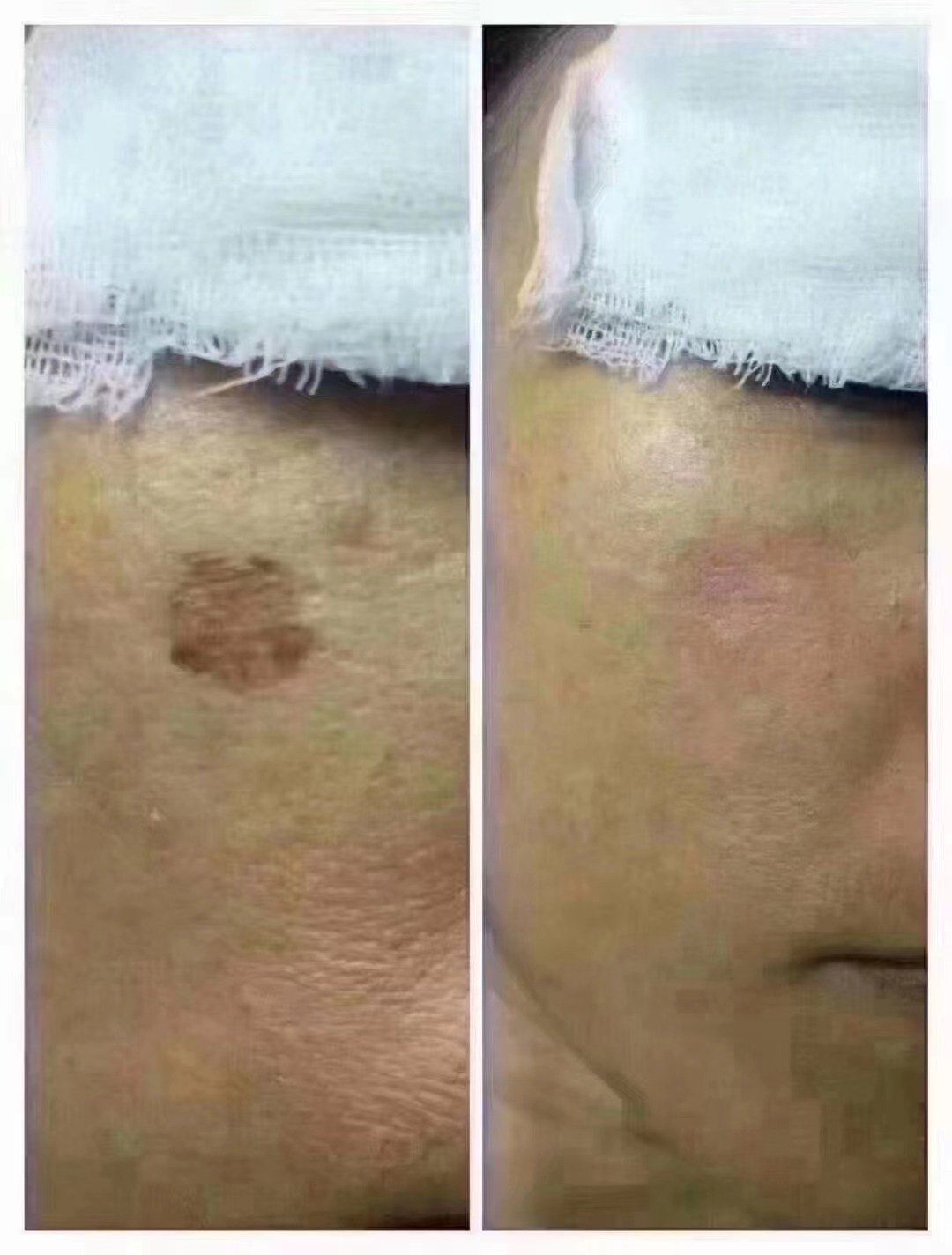 老年斑:医学名脂溢性角化症