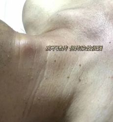 -瑶芳清颜草本祛痘