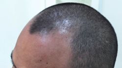 -雍禾植发全国连锁