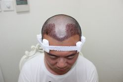 点击看大图 -大麦微针植发丨全国连锁