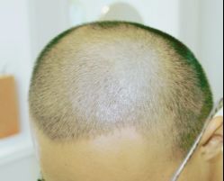 -大麦微针植发丨全国连锁