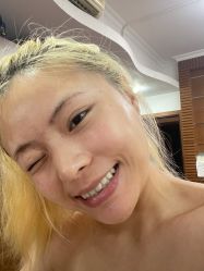 体验后-广州健丽·去眼袋医疗美容机构