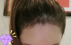 -大麦微针植发丨全国连锁