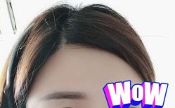 -大麦微针植发丨全国连锁