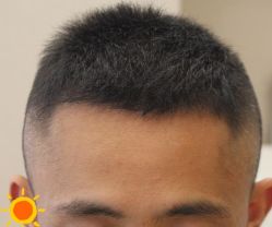 -大麦微针植发丨全国连锁