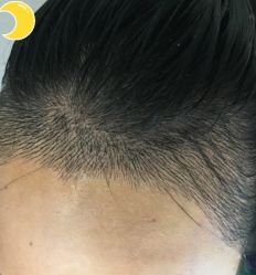 -大麦微针植发丨全国连锁