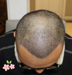 -大麦微针植发丨全国连锁