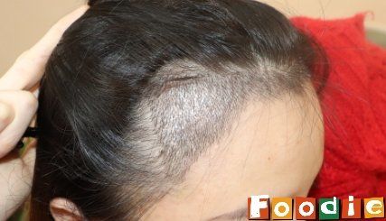 -大麦微针植发丨全国连锁