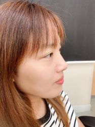 体验后-北京米扬丽格医疗美容·联合丽格鼻整形中心