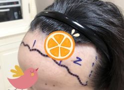 -大麦微针植发全国连锁