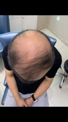 -大麦微针植发全国连锁