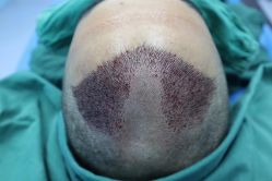 -大麦微针植发全国连锁