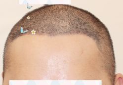 -大麦微针植发全国连锁